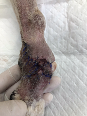 足先の腫瘍の手術４